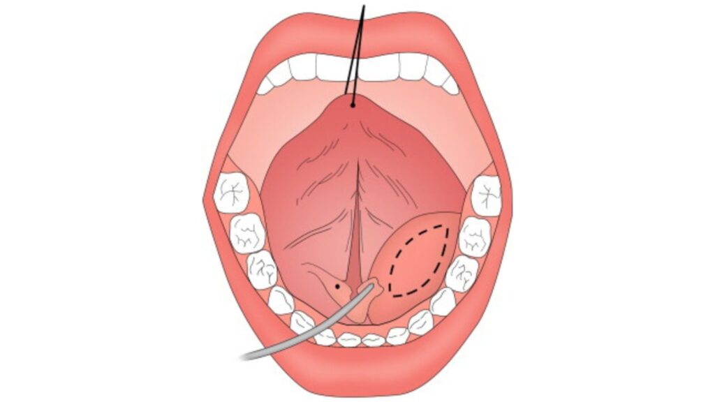 Throat Disorders Treatments in Gurgaon